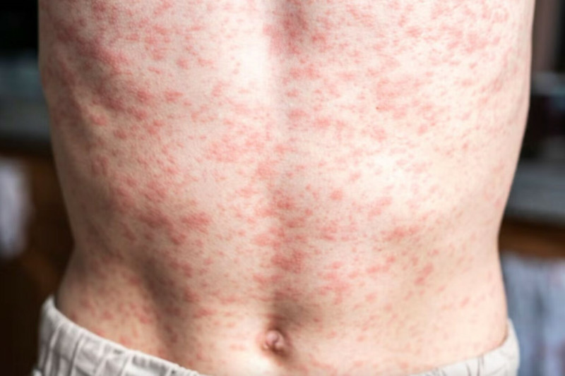 Aumentan muertes por sarampión en México; CDMX reporta primer deceso