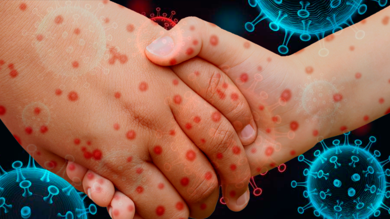 México registra casi 14 mil casos de sarampión y 35 muertes