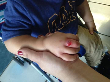 Fumigan Cendi donde araña violinista pico a un infante