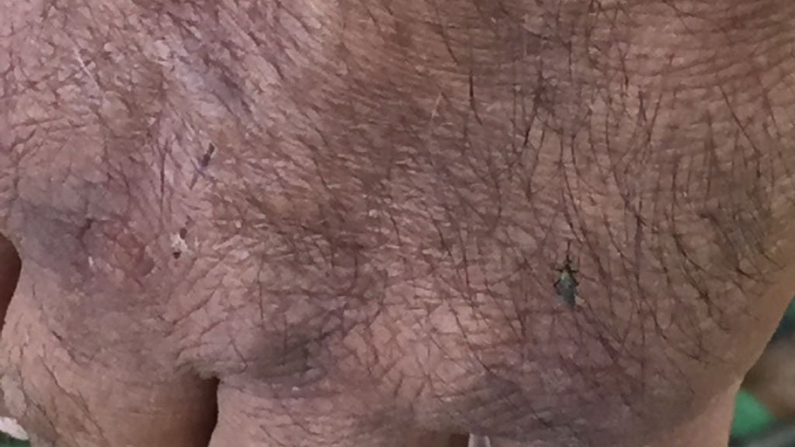 Autoridades aseguran que es baja la incidencia de dengue en Altamira