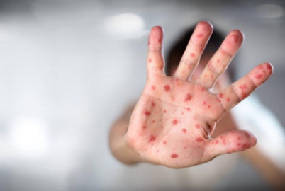 Viruela símica no será pandemia; aún hay incógnitas, asegura la OMS