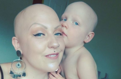 ¡Ser calva es hermoso!