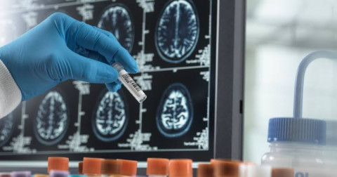 Encuentran problemas de seguridad en farmaco experimental que ayudaría a retrasar el alzheimer