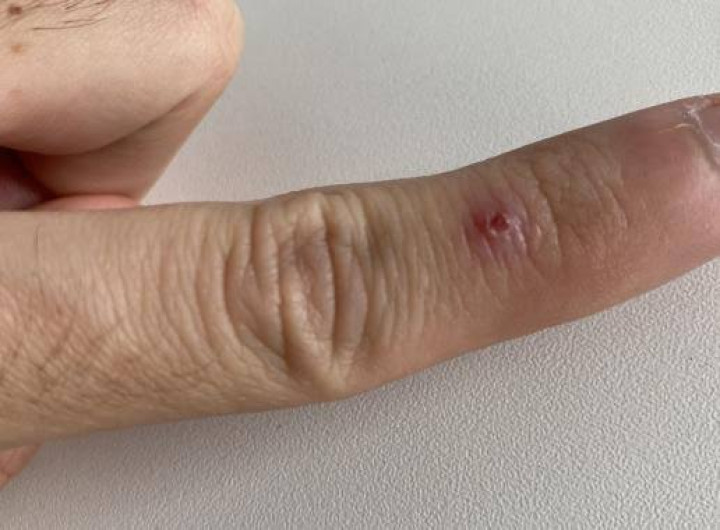 Condado Cameron confirma primer caso de Viruela del mono