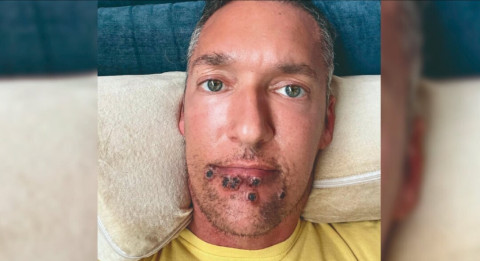 Actor comparte su experiencia con la viruela símica 