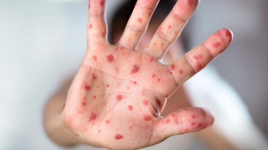 La OMS cambiará el nombre de la viruela del mono