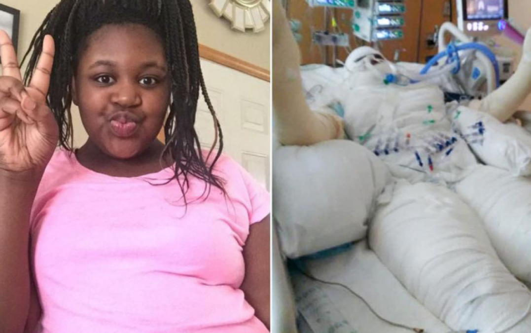 Niña a punto de morir por el #FireChallenge