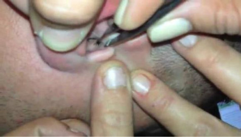 Acude al hospital por un dolor en el oído y descubre que tenía una cucaracha 