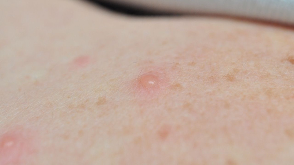 Confirman más de 200 casos de viruela del mono en el mundo