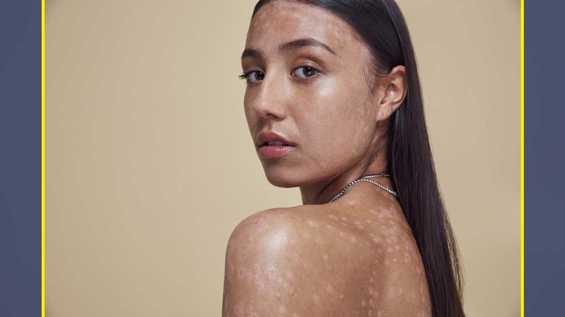 Así celebramos los "defectos" en la piel