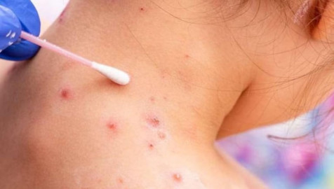 OMS autoriza prueba de diagnóstico de la viruela del mono para uso de emergencia