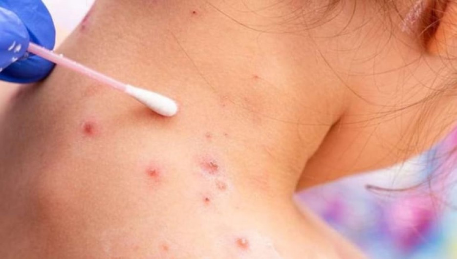 OMS autoriza prueba de diagnóstico de la viruela del mono para uso de emergencia