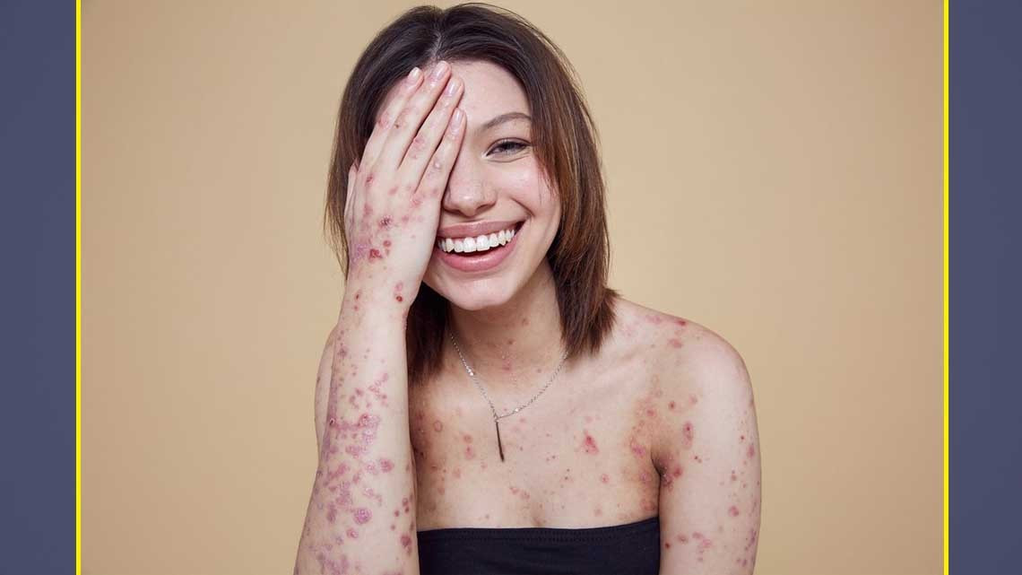 Así celebramos los "defectos" en la piel