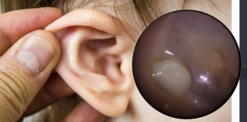 Extraen un diente del oído de un niño