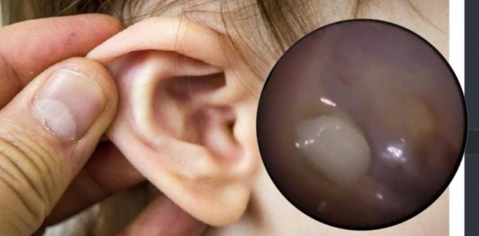 Extraen un diente del oído de un niño