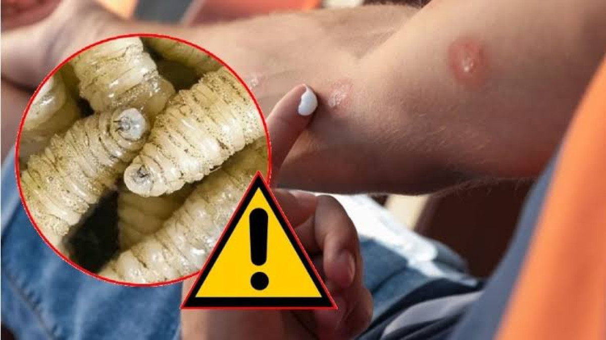 Confirman cuatro casos de miasis por gusano barrenador en humanos en México