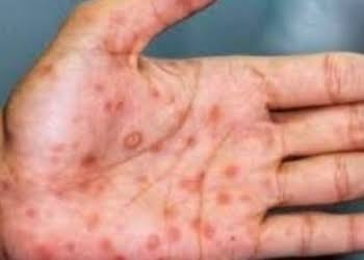 Casos globales de viruela del mono ascienden a 14 mil en más de 70 países