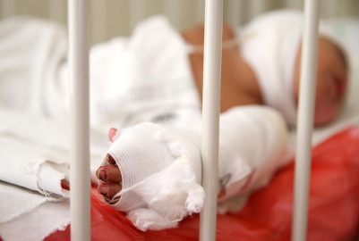 Reynosa, municipio con más accidentes por quemaduras en Tamaulipas