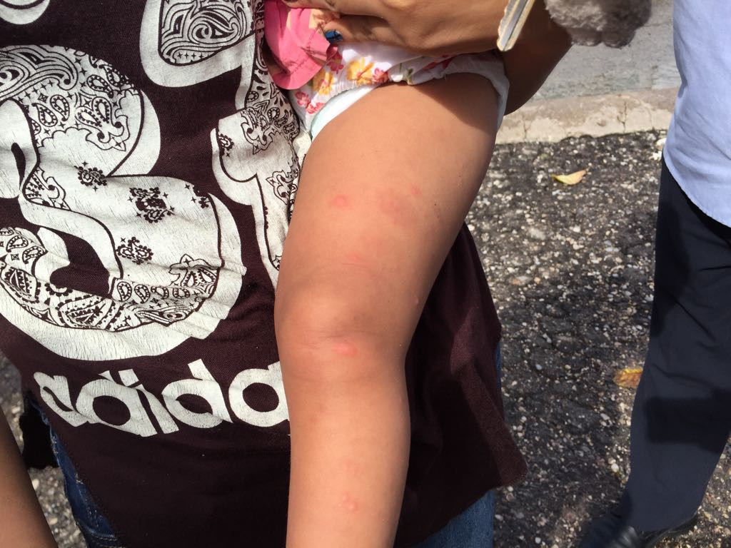 Surgen brotes de infección en la piel, tras inundaciónes