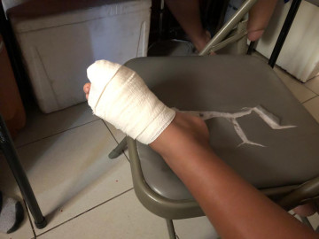 Explota transformador de la CFE y lesiona a menor 