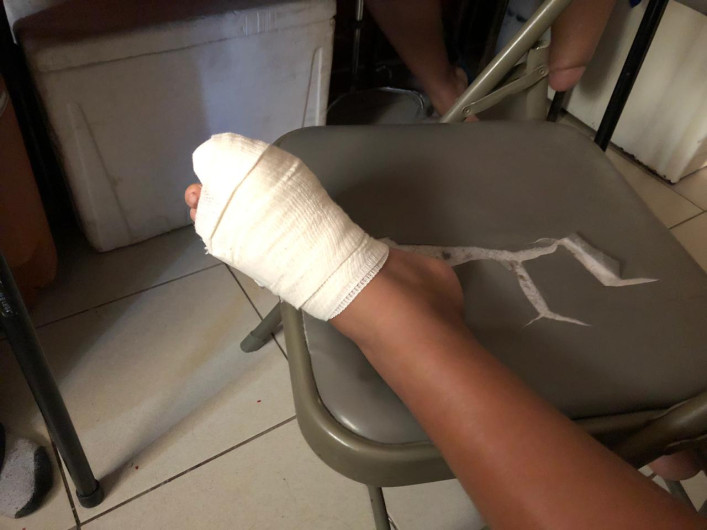 Explota transformador de la CFE y lesiona a menor 