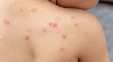 Alerta OPS sobre que América es el epicentro de la viruela del mono