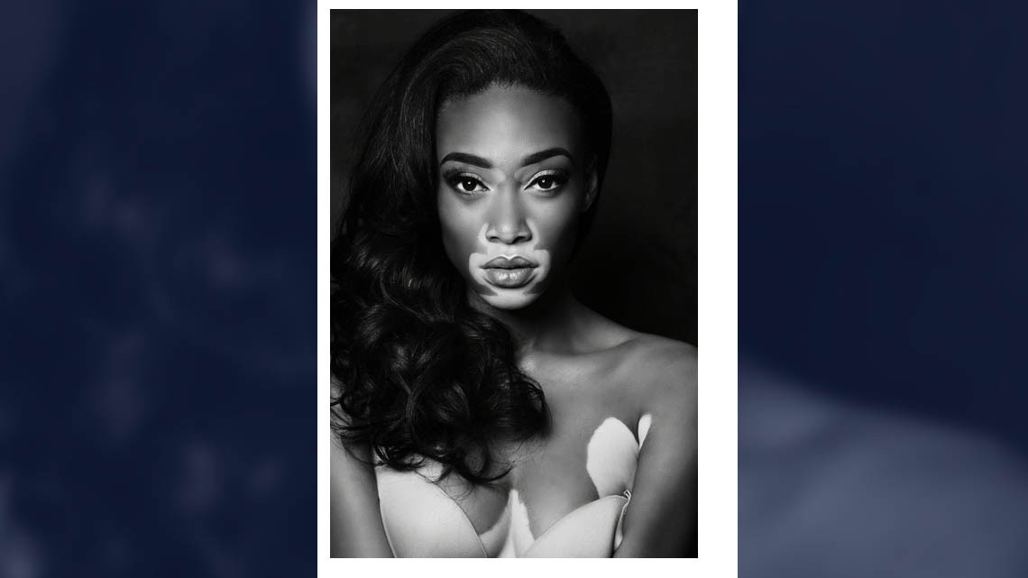 Winnie Harlow es elegida para desfilar en Victoria's Secret