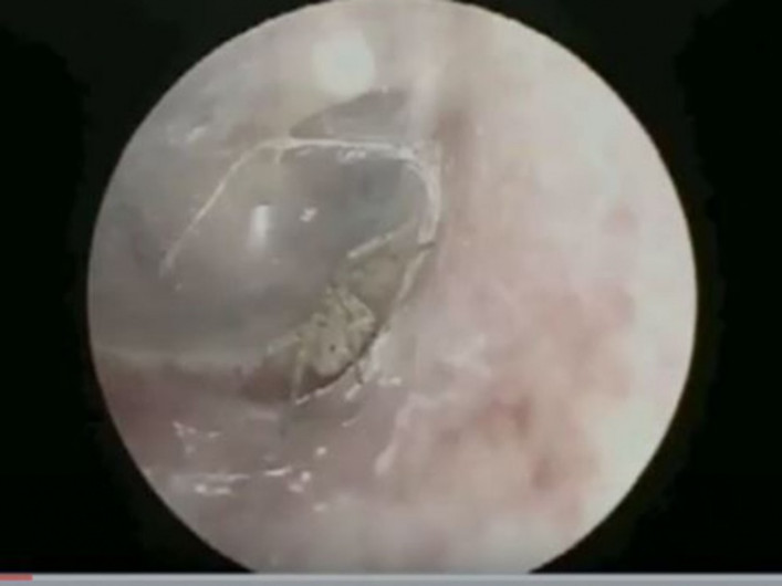 Descubre araña tejiendo su telaraña dentro de su oído