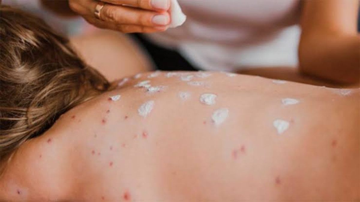 Aumentan a 421 los casos de sarampión en México