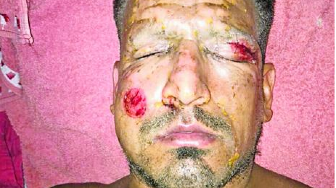 Jürgen Damm sufrió un accidente con pirotecnia