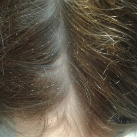 Registran menos casos de pediculosis, exhortan a no dormir con cabello húmedo