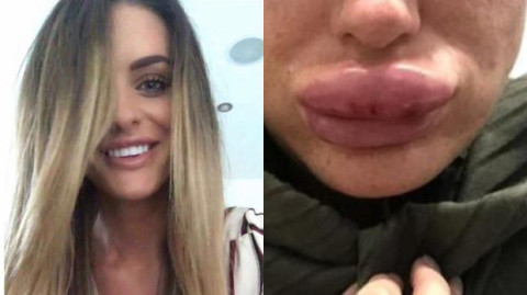 “Una fiesta de botox”