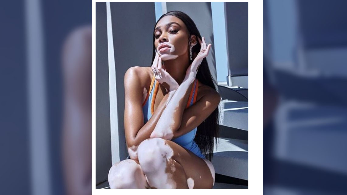 Winnie Harlow es elegida para desfilar en Victoria's Secret