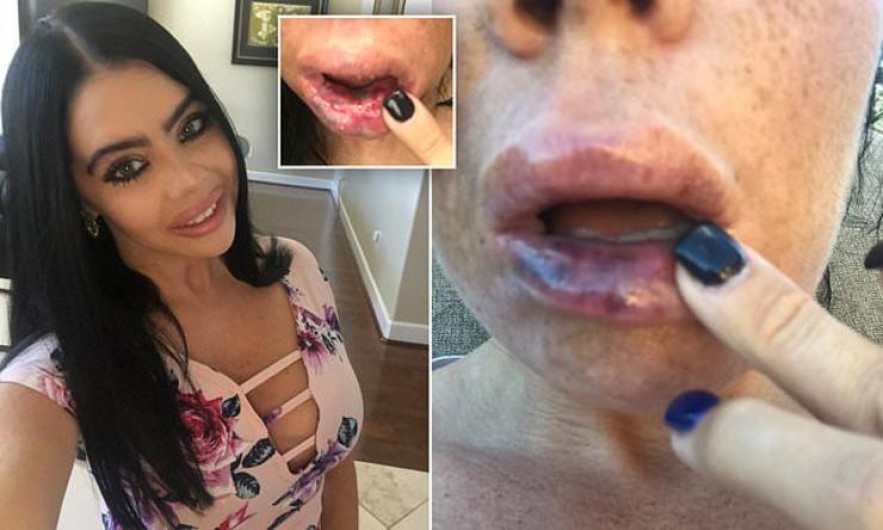 Mujer queda irreconocible tras mal procedimiento de relleno