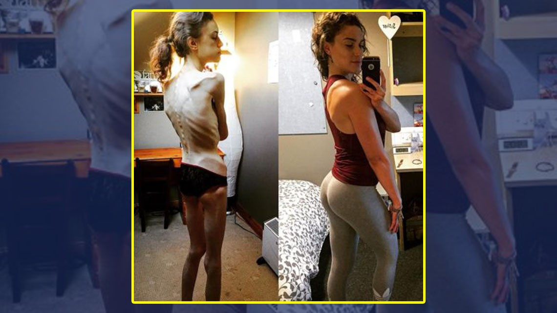 Chica muestra su recuperación tras anorexia