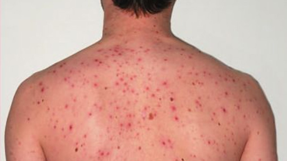 Brote de Sarampión que viene de los Estados Unidos