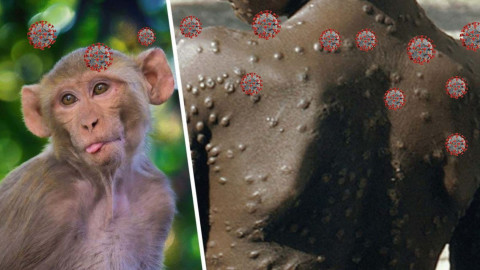 Kenia registra su primer caso mpox, antes viruela del mono