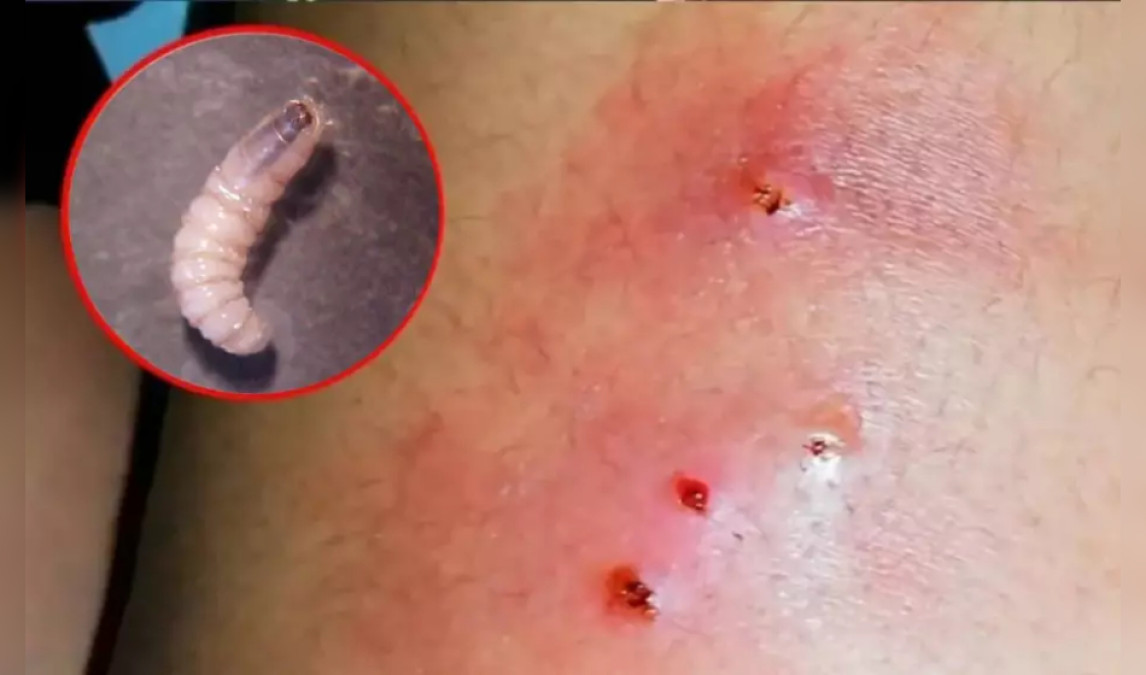 Honduras registra 27 casos de gusano barrenador en humanos y tres muertes