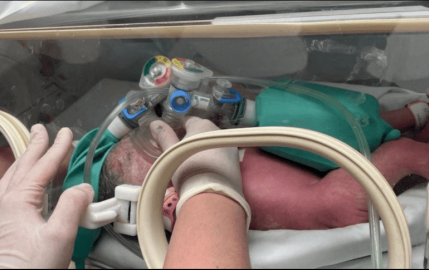 Nacen siamesas en el Hospital Regional Materno Infantil en NL