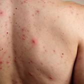 M&eacute;xico registra 24 muertes y m&aacute;s de 5 mil 700 casos de sarampi&oacute;n, alerta Salud