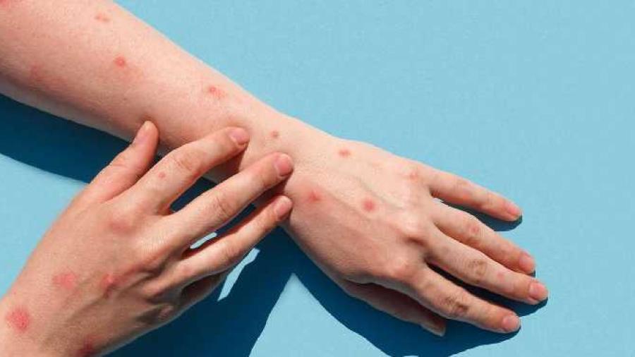 Suma México 504 casos de viruela del mono 