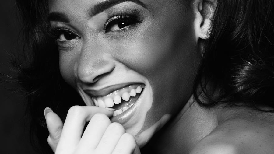 Winnie Harlow es elegida para desfilar en Victoria's Secret