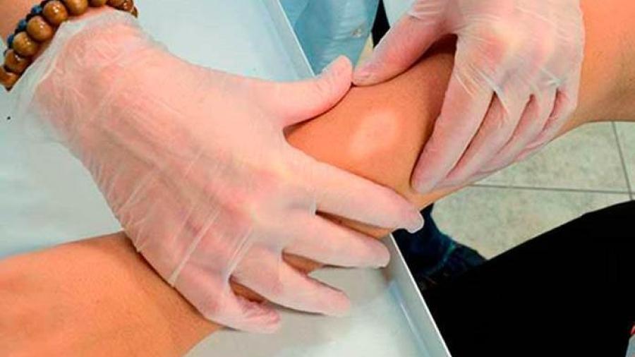 La Ssa vigila 12 municipios por casos de lepra