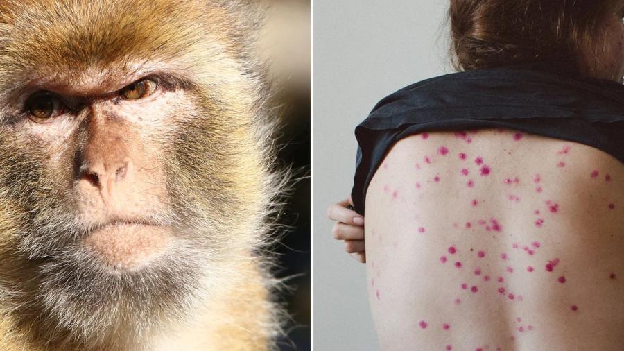 Habrá orientación telefónica y página web sobre viruela símica 