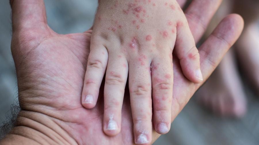 Autoridades emiten alerta sanitaria por brote de virus Coxsackie; Reynosa con mayor número de casos 
