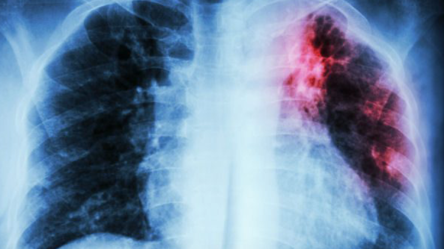 Detectan más casos de Tuberculosis en Nuevo Laredo