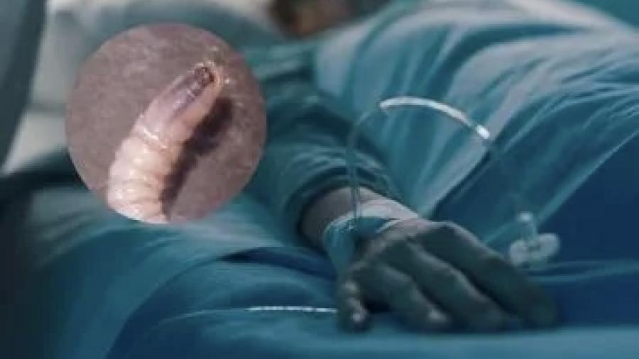 Confirman octavo caso de miasis por gusano barrenador en Yucat&aacute;n; es el primero en M&eacute;rida