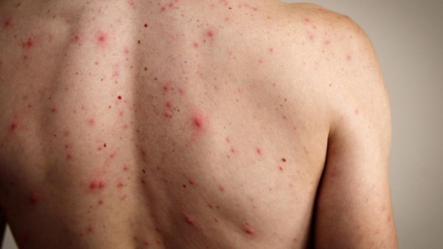 M&eacute;xico registra 24 muertes y m&aacute;s de 5 mil 700 casos de sarampi&oacute;n, alerta Salud