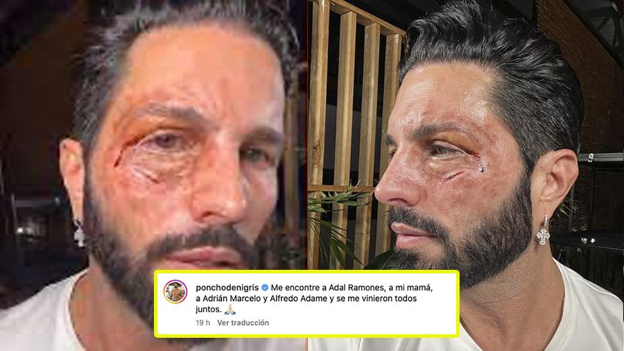 Poncho de Nigris aparece con el rostro golpeado: "Se me vinieron todos juntos"