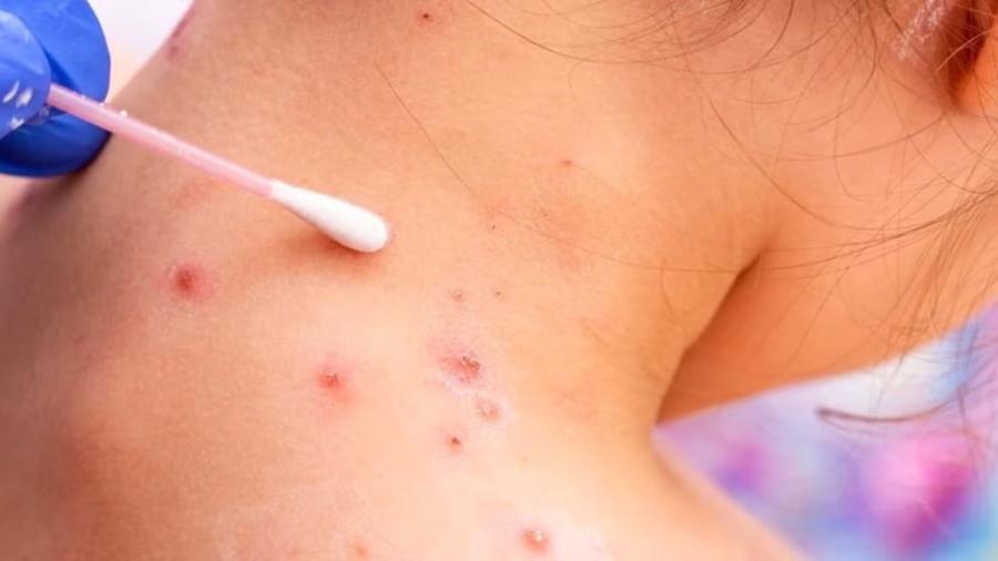 Registran más de 60 casos de viruela del mono en los últimos 14 días